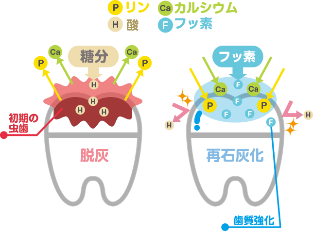 初期のむし歯を治してくれるから