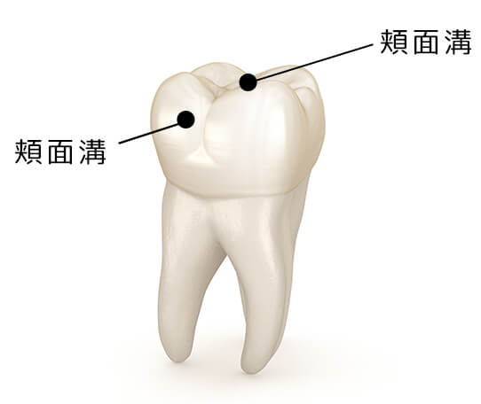 むし歯になりやすい歯があるため