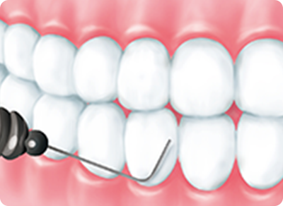歯石の除去