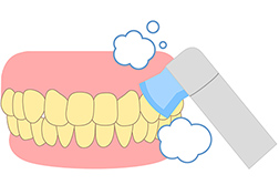 STEP.02 歯面清掃